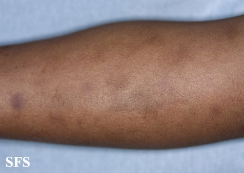arm rash.jpg